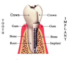 a dental implant (right)
