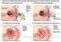 Remove <b>Retained Placenta</b> with Subsquent Asherman's Syndrome