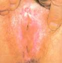 <b>Lichen sclerosus</b> et