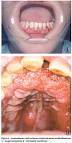 <b>Doenças doencas</b> micose <b>boca</b>