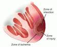 Myocardial <b>infarction</b> shown in