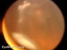 <b>Pars planitis</b>