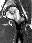 of the <b>Femoral Head</b>