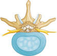 Lumbar SPINAL STENOSIS - Your Orthopaedic Connection - AAOS
