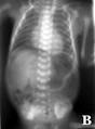 <b>Perforación intestinal</b>