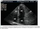 com <b>disfunção ventricular</b>