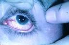 <b>Ataxia</b>-telangiectasia2.gif