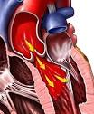 <b>Aortic Valve Insufficiency</b>