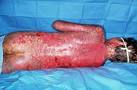 <b>Stevens Johnson Syndrome</b> was