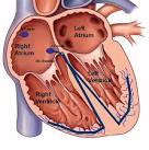 Atrial <b>tachycardia</b> is seen in