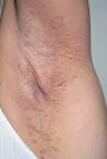 <b>Fox Fordyce Disease</b>