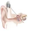220px-Cochlear_implant.jpg