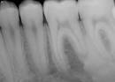 Idiopathic <b>Osteosclerosis</b>