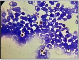 Image result for Cryptococcosis, disseminated Rule Outs