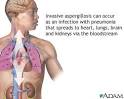 Pulmonary <b>aspergillosis</b>
