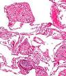 <b>Foreign body granuloma</b>