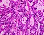 File:<b>Adenocarcinoma</b> moderate differentiated (rectum) H&E magn 400x
