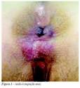 atingindo a margem <b>anal</b> e