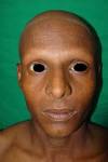 <b>Ichthyosis</b> follicularis with