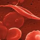 SICKLE CELL TRAIT – are athletes at risk? « Texas Health Athlete