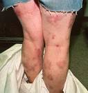Spider bites, meth sores, speed bumps, crank bugs, crank sores ...