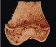 Osteogénesis Imperfecta (página 2) - Monografias.