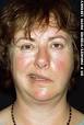 Bell's palsy - What is Bell's palsy? - Best Health