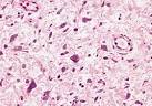 Soft tissue Tumors - Giant cell fibroblastoma