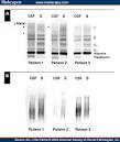 The <b>oligoclonal bands</b> (OCBs)