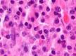 Micrograph of a <b>plasmacytoma</b>.
