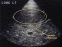<b>hiperplasia nodular focal</b>