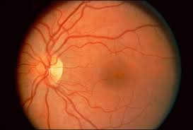 علاج تلف شبكية العين بالخلايا الجذعية  Images?q=tbn:ANd9GcTck2ZdPbRa9jcC-jnFnqdlGymVumW0IQ9o-utZZ5K0qlnNID6u
