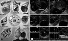 Las <b>neoplasias</b> benignas del