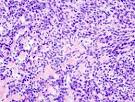 File:<b>Pleomorphic adenoma</b> (3)