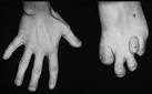 As <b>Refsum disease</b> is an
