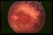 <b>Retinitis pigmentosa</b> - Wikipedia, the free encyclopedia