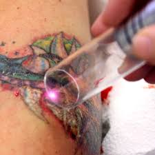 Celebrity Tattoo Removal - Stories of Tattoo Regret