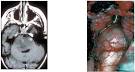 Tumores de <b>tronco</b> cerebral