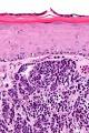 a <b>Merkel cell carcinoma</b>.