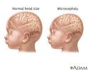 <b>Microcephaly</b> is a head size