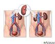 Kidney <b>transplant</b> · Kidney