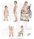 Muscular Dystrophy treatment | Health tips