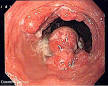 ESOPHAGEAL CANCER - Wikipedia, the free encyclopedia