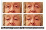 Common <b>eye manifestations</b> due