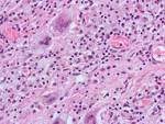 File:Giant cells1.jpg - Wikimedia Commons