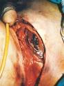 <b>Gangrena de Fournier</b> afectando
