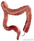 What Is an Enlarged <b>Colon</b>? (with picture)