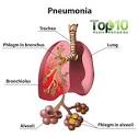 Home Remedies for PNEUMONIA | Top 10 Home Remedies