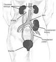 The <b>Transplant</b> Process