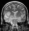 with <b>encephalitis</b>.